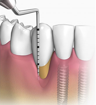 Dental bone surgery Karachi