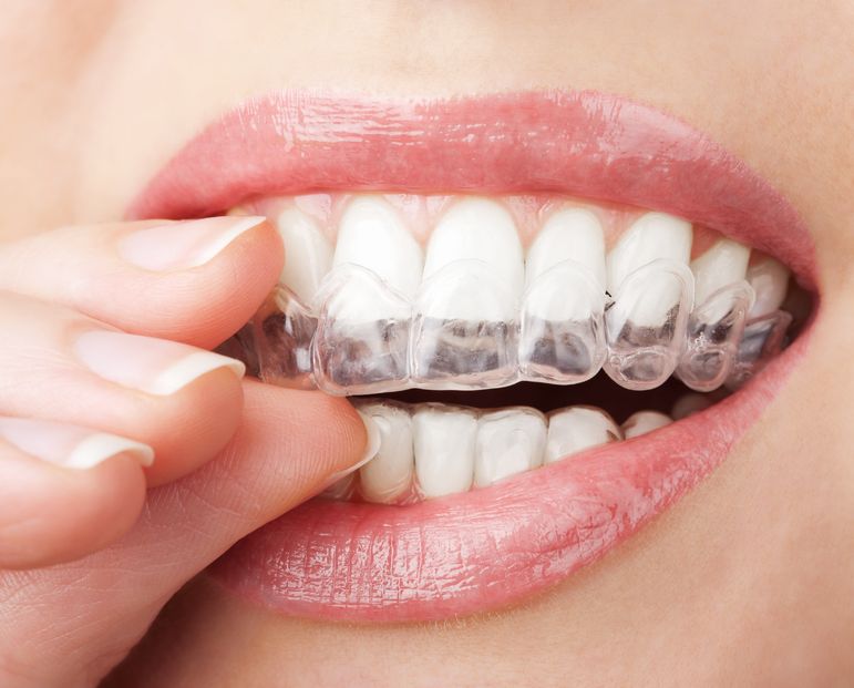 Adult-Orthodontics