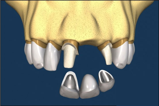 Bridges-2 Dental Bridge Treatment in Karachi