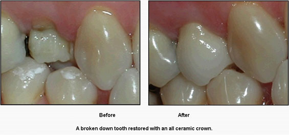 Crowns Best Cosmetic Dentist for Crowns in Karachi