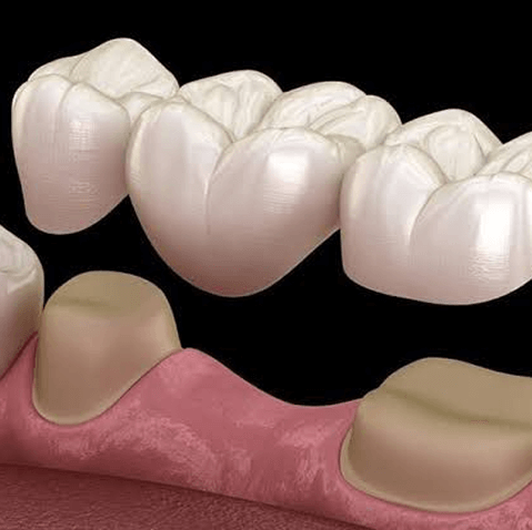 Crowns & Bridges at Altamash Dental Clinic