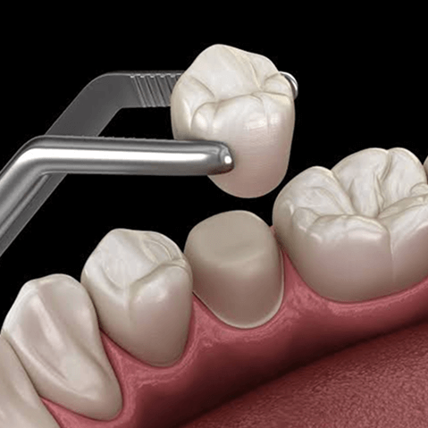 Best Dental Crown And Bridges Treatment In Pakistan