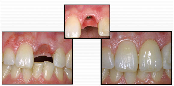 Best Dental Implants Treatment