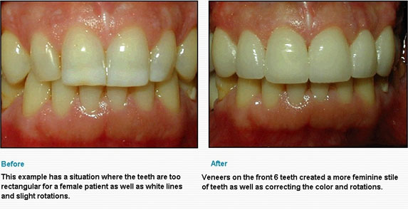 Best Indirect-Veneers