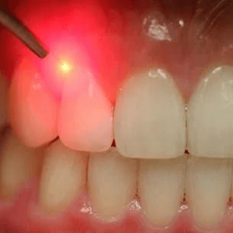 Best Laser Dental Treatment at Altamash Clinic