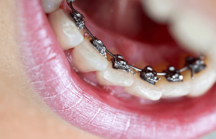 Orthodontics Treatment at Altamash Clinic