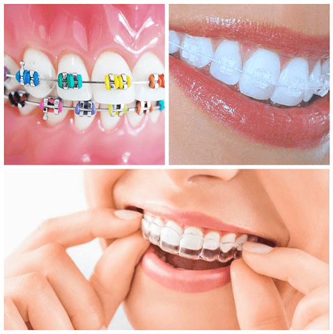 Orthodontics at Altamash Clinic
