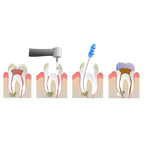 Painless Rootcanals Treatment at Altamash Clinic