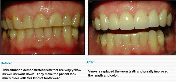 Best Porcelain-Veneers