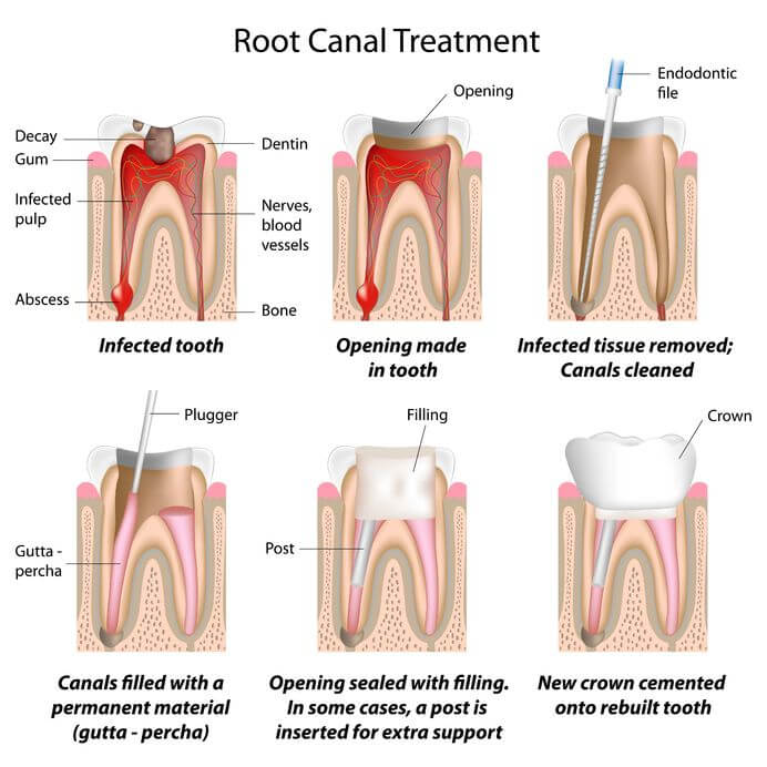 Best Root Canal Treatment