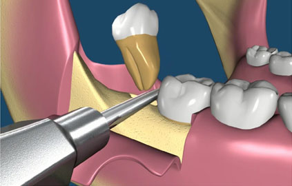 Best dentist for tooth removal in Karachi