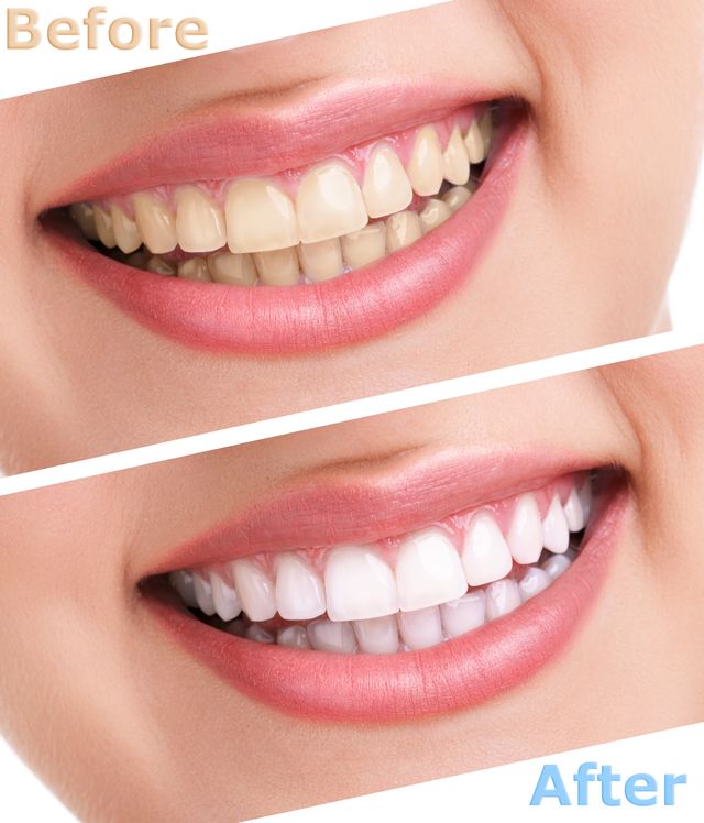 Best Tooth-Whitening In Pakistan