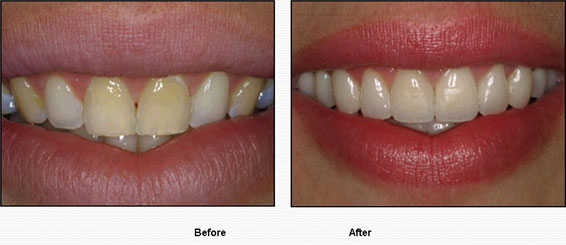 Best veneers in Karachi