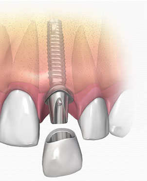 Best Dental Treatment at Altamash Clinic