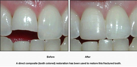 Tooth bonding Karachi