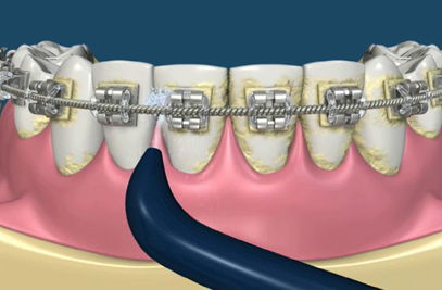 Best Braces-Waterpick Treatment In Pakistan