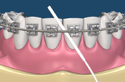 Best Braces Wire In Pakistan