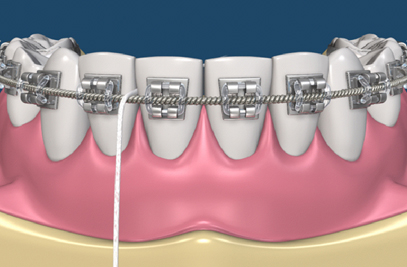 Best Braces Wire In Pakistan