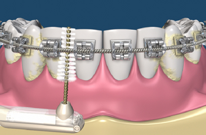 Best braces in Karachi