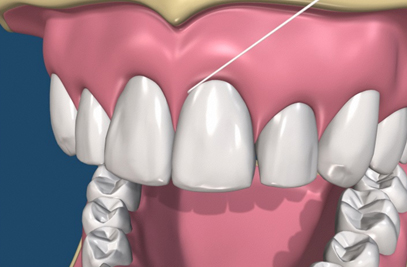 Best flossing technique