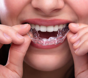Orthodontic Treatment at Altamash Clinic
